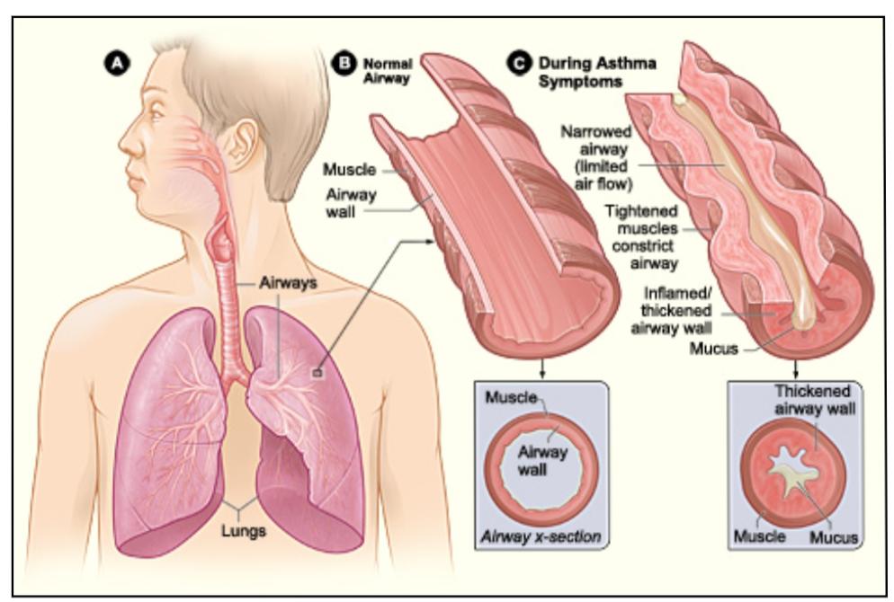 asthma-diagram-with-normal-airway-and-asthmatic-airway-3244164-vector