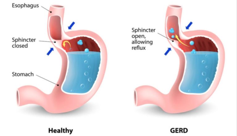 GERD ICD 10 Codes - Coding guidelines with examples