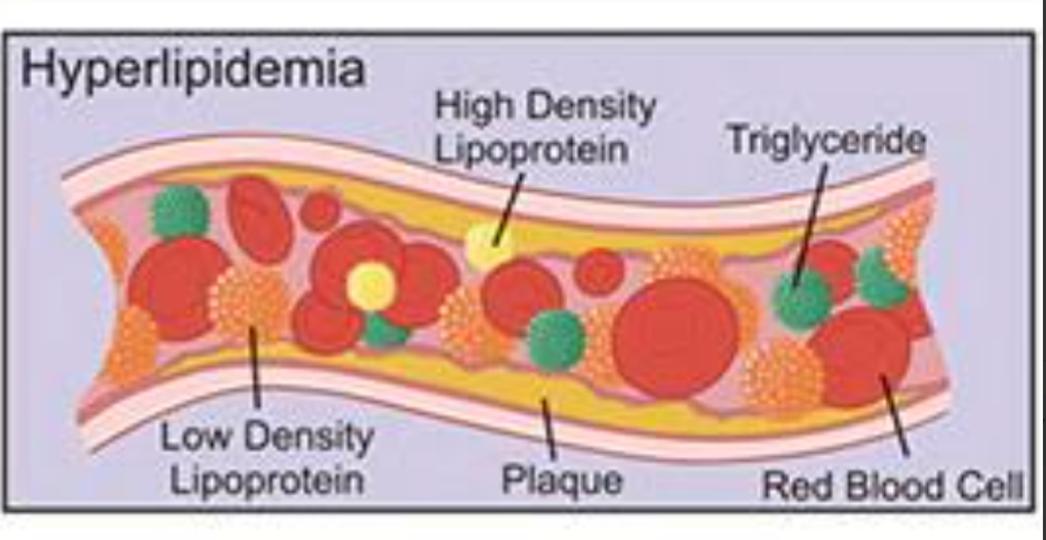 Hyperlipidemia ICD 10 Coding guidelines with examples